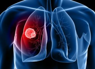 Science. Des chercheurs développent un modèle d’IA capable de détecter les risques de cancer du poumon
