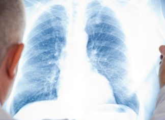 Fibrose pulmonaire idiopathique : l’Alliance des maladies rares appelle à garantir l’accès aux médicaments